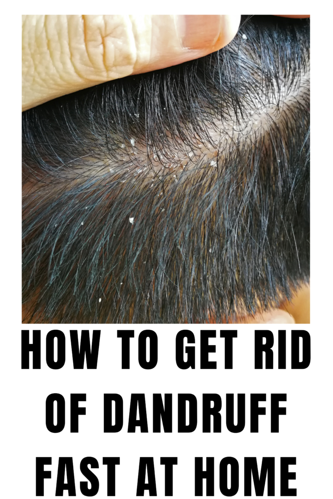 How to Get Rid of Dandruff Fast at Home