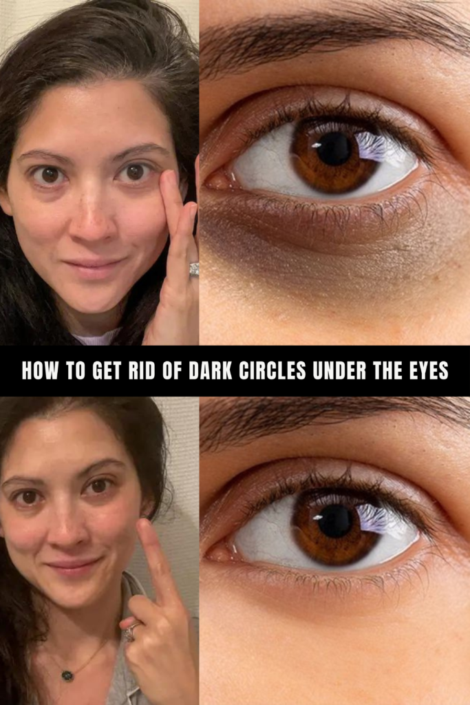 Dark Circles Under the Eyes