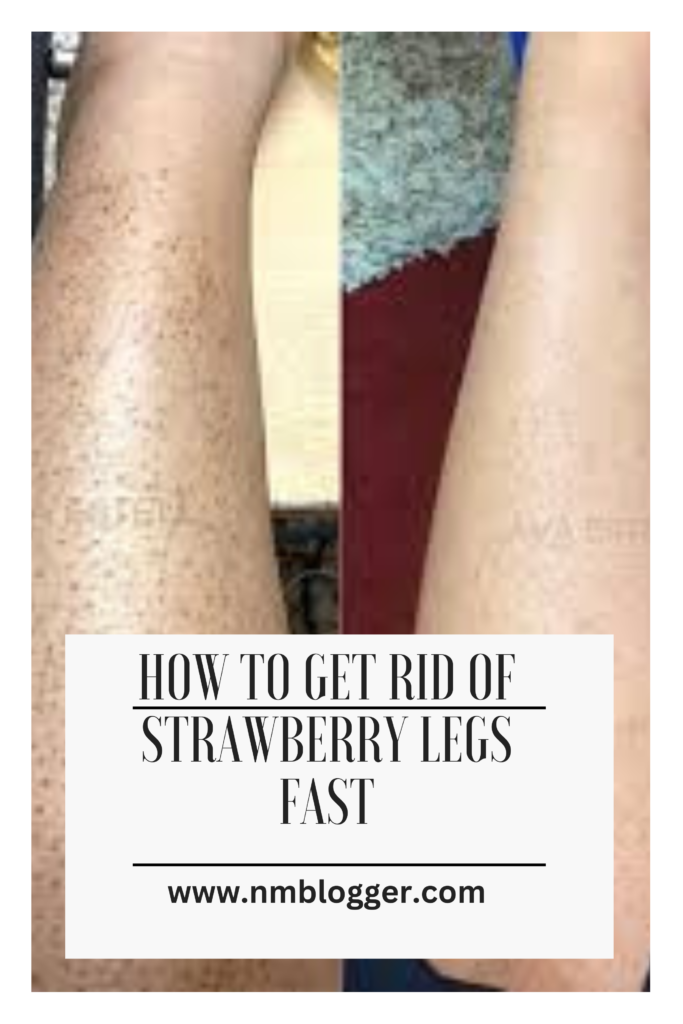 How to Get Rid of Strawberry Legs Fast