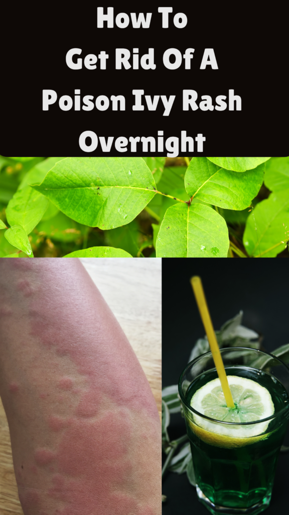 How To Get Rid Of A Poison Ivy Rash Overnight