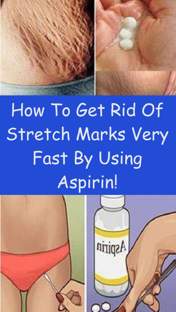 How To Get Rid Of Stretch Marks Very Fast By Using Aspirin!